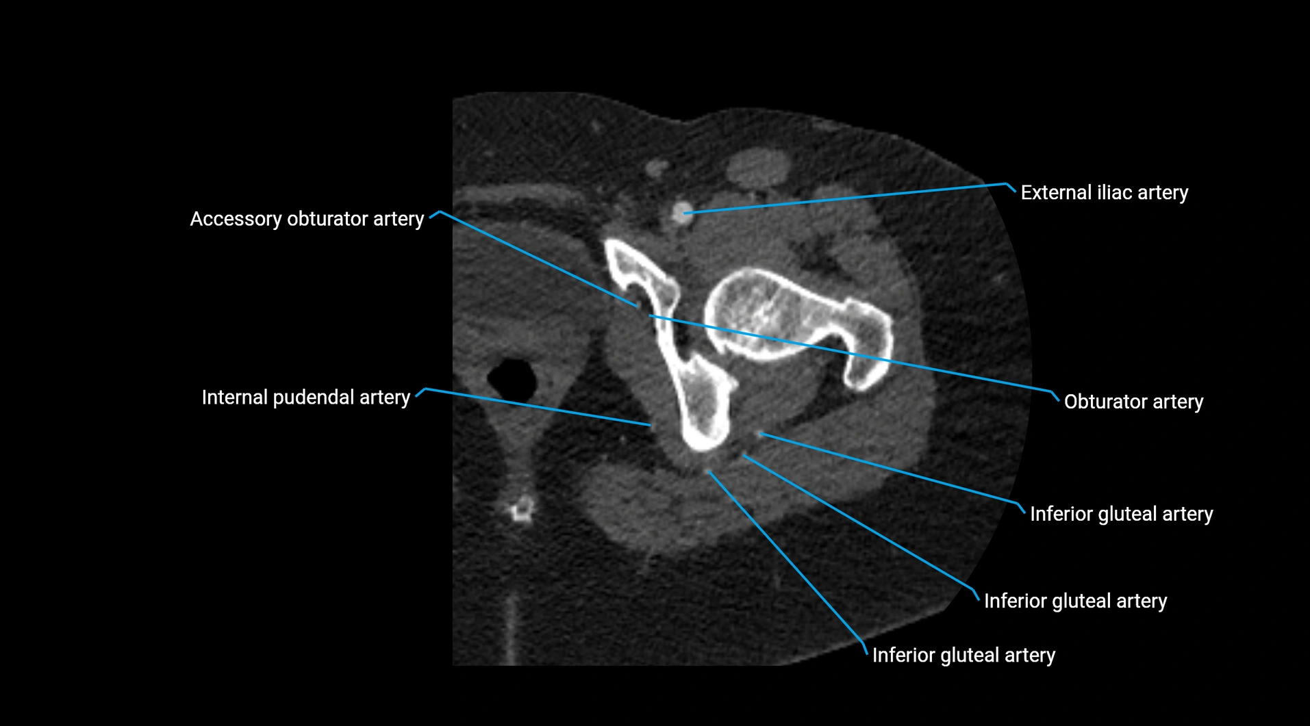 CTA lower limb cross sectional anatomy labelled image _59.webp